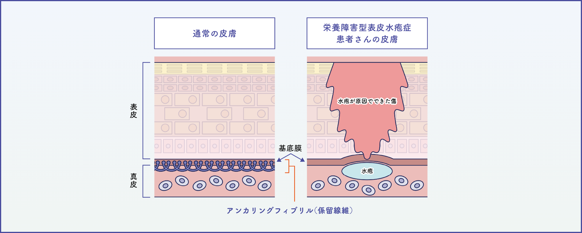 通常の皮膚と栄養障害型表皮水疱症の患者さんの皮膚のイメージ図