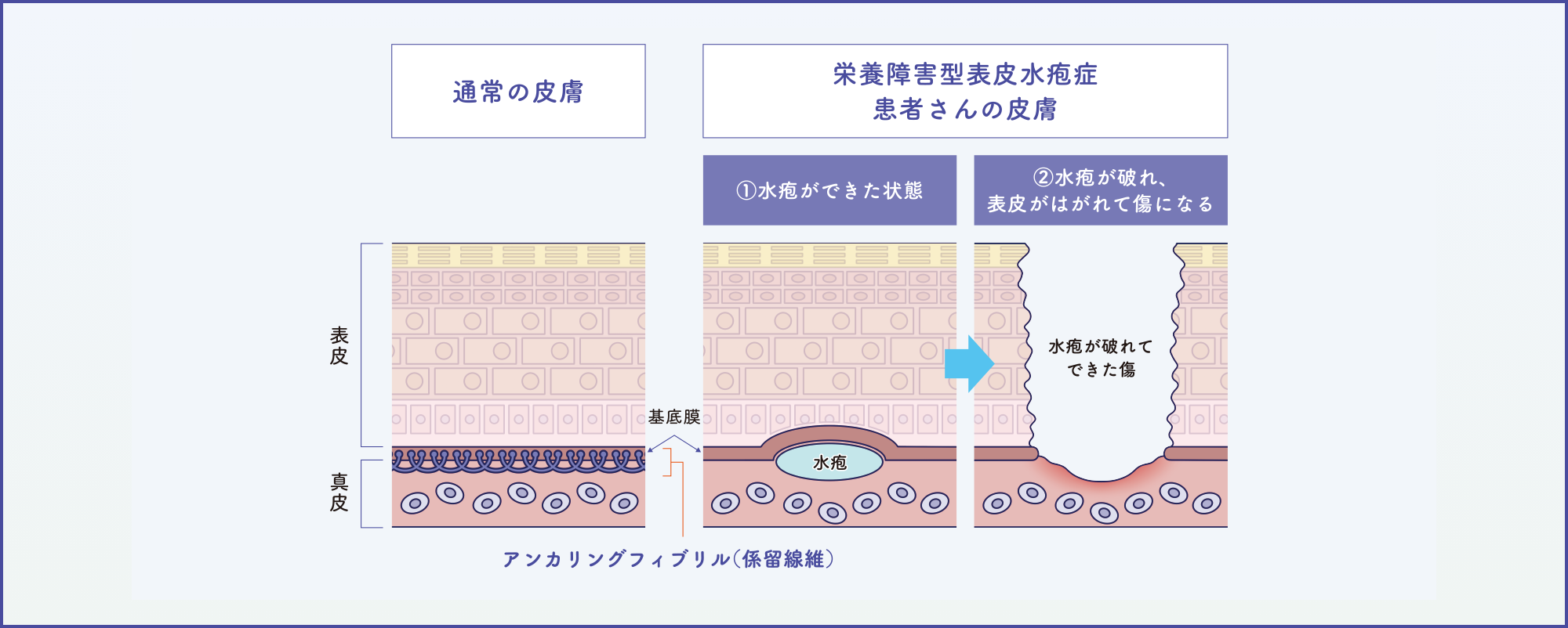通常の皮膚と栄養障害型表皮水疱症の患者さんの皮膚のイメージ図